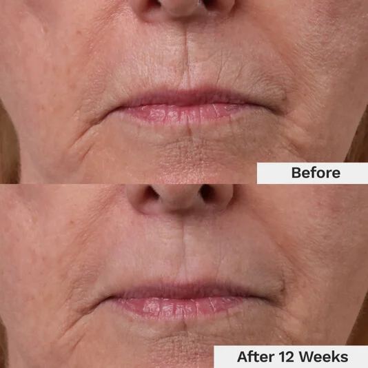 Luxevéria® Line Therapy 13 ba 1